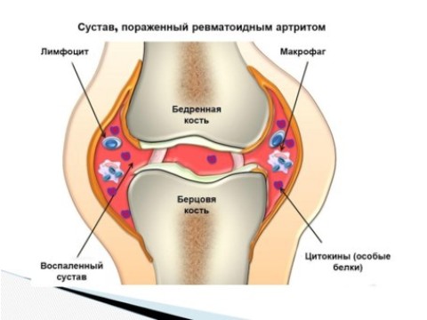 Опорно-двигательная система (ревматоидный артрит)